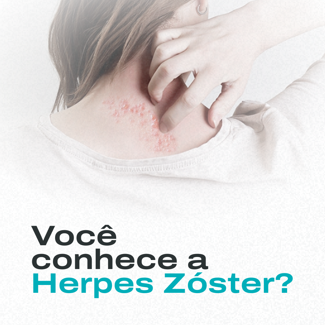 Herpes-zóster: o que é, sintomas, diagnóstico, tratamento e prevenção 